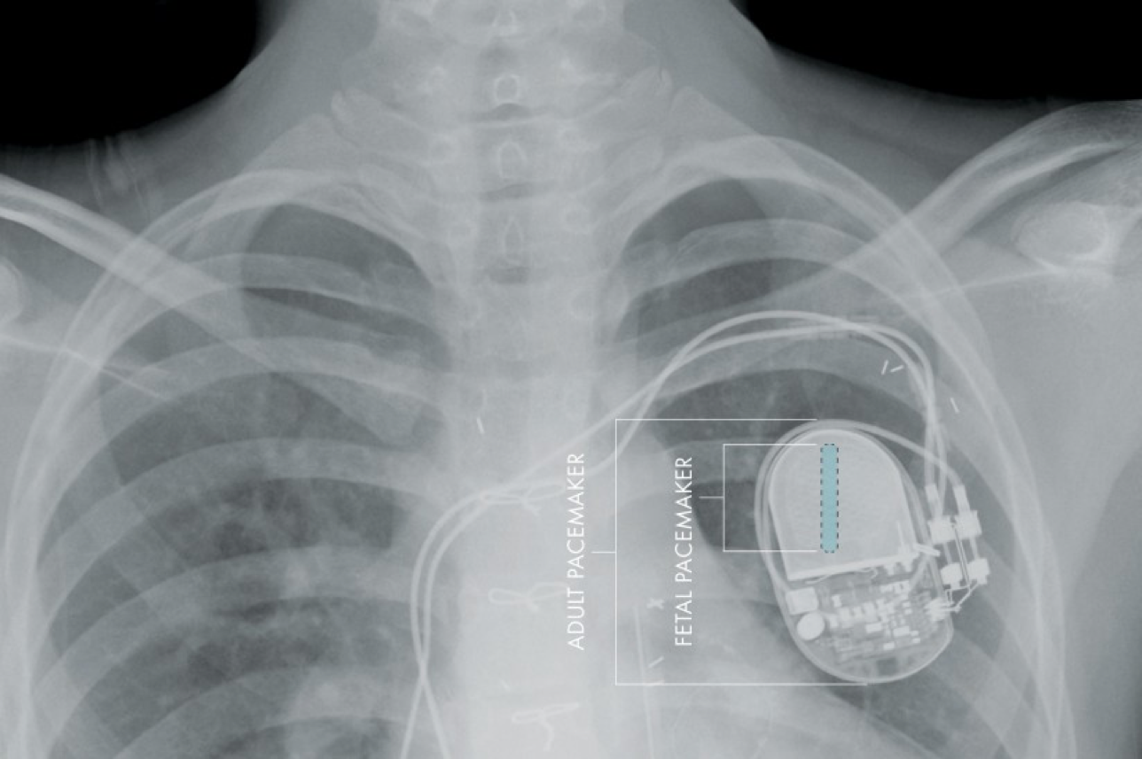 FDA recalls 465,000 pacemakers open to cyber attack